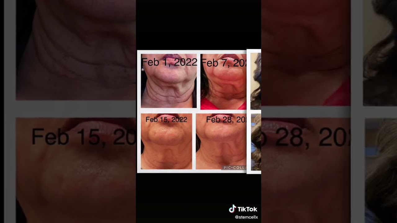 x39 stem cell patch - broken foot testimony @x39stemcell